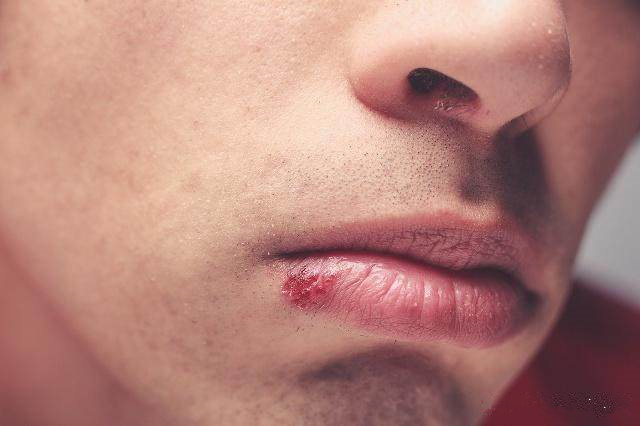 嘴唇总是干裂、起皮、发炎？你可能忽略了这几点
