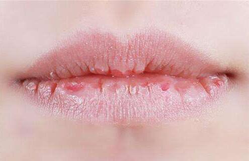 嘴唇上有水泡吗？一年中发生3次以上的唇疱疹发作是一个警告信号