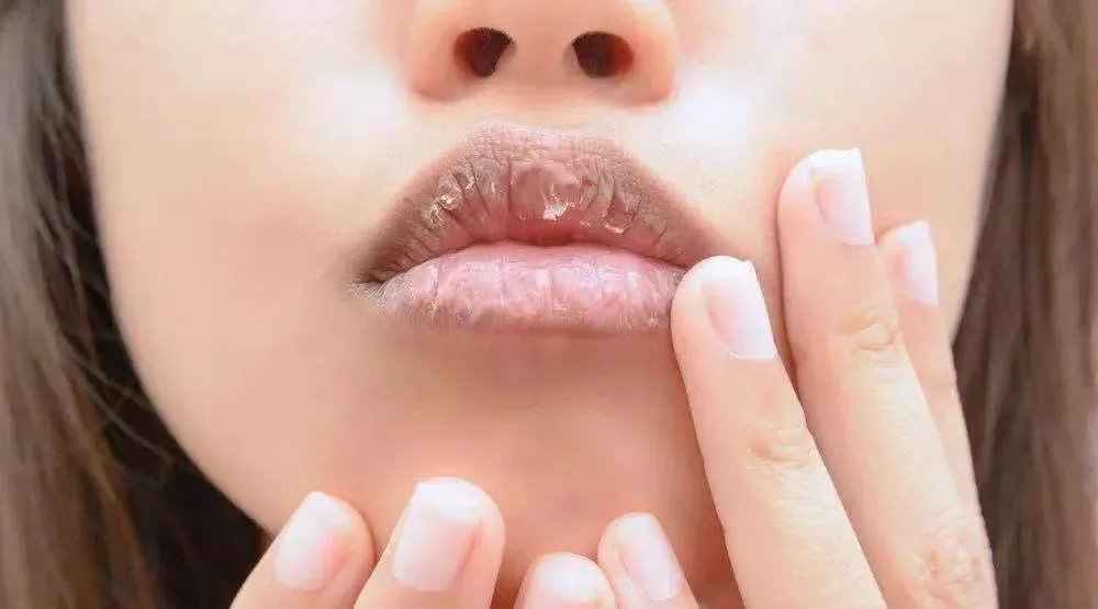 嘴唇干了吗？尝试以下5种针对唇裂的家庭疗法