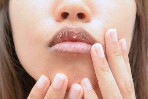 唇炎的病发原因有哪些