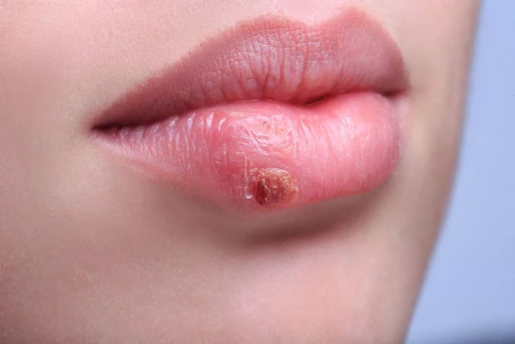 嘴唇长小水泡是唇疱疹还是口角炎？「唇疱疹」会传染，这样做快点好、防复发
