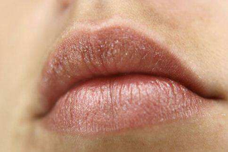 唇炎是怎么引起的 四个原因导致嘴唇脱屑疼痛