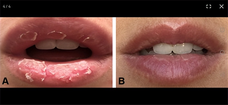 唇炎（别名：嘴唇发炎）的症状和治疗方法