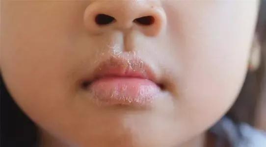 孩子不同口唇病 治疗有别