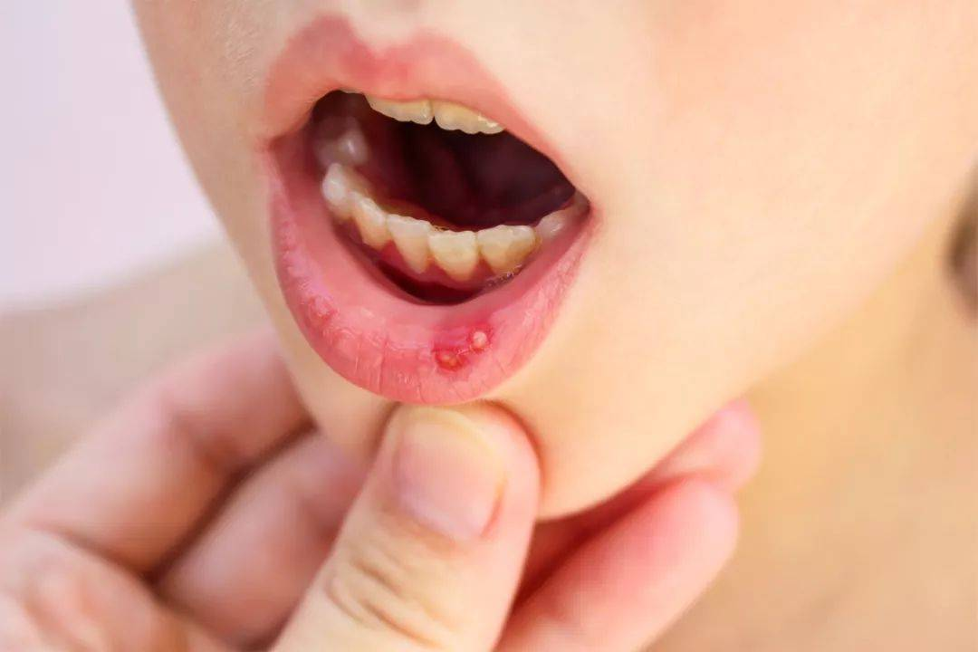 10种常见的口腔黏膜疾病，不可轻视，及早治疗为上策