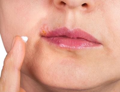 因唇炎引起的口角炎如何治疗