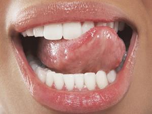 维生素缺乏引发唇炎 唇炎有哪些明显特征
