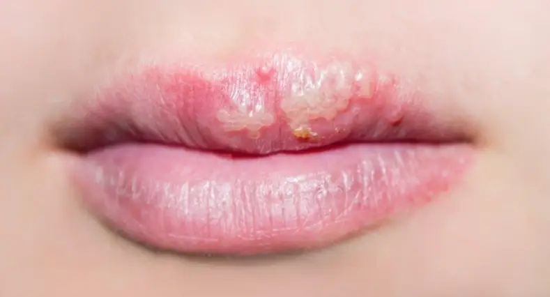 关于唇炎的那些事儿，你了解多少？