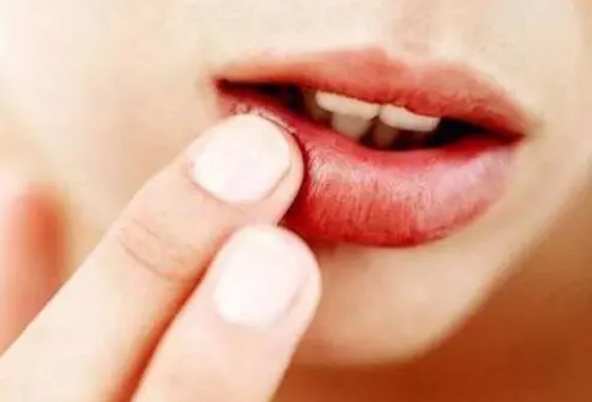 5种常见的唇炎，教你如何区分诊断！